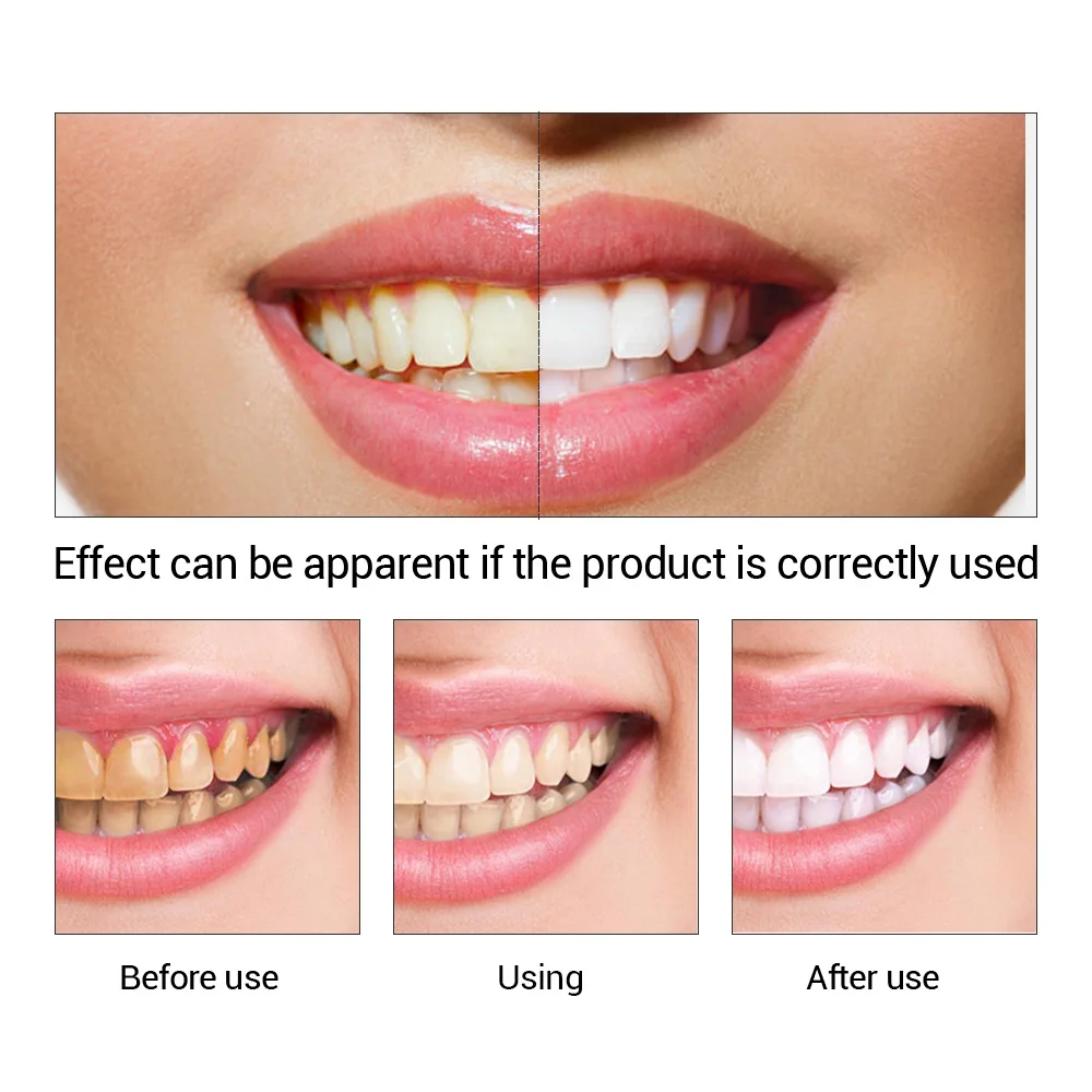 FTEENPLY Teeth Whitening Essen - Teeth Whitening Levels 评论和价格